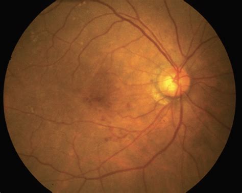 wet amd|Iba pa.